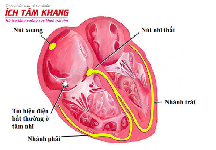 Ngoại tâm thu nhĩ (NTTN) là sự co bóp tự phát của tế bào cơ tim
